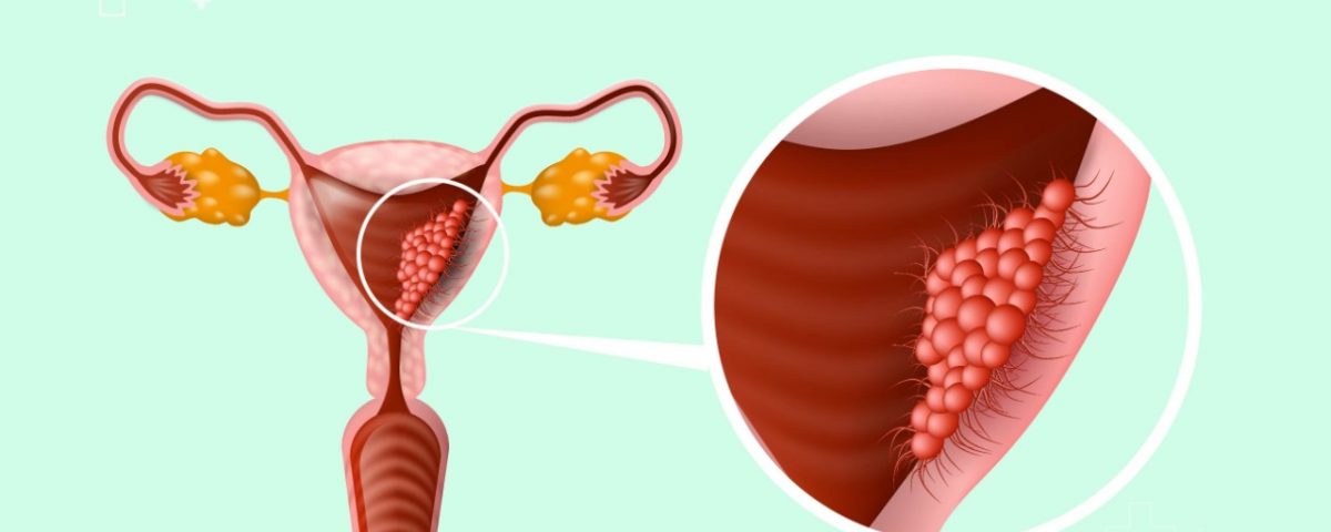 Desinflamar el intestino medicamento